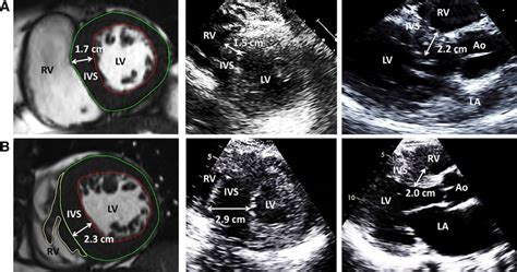 mildly increased septal wall thickness.